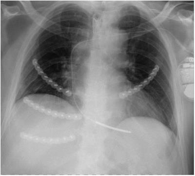 Outcomes after fixation of rib fractures sustained during cardiopulmonary resuscitation: A retrospective single center analysis